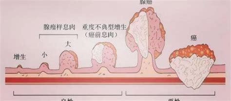 肠镜息肉切除多少钱（1厘米的肠息肉） 科技田