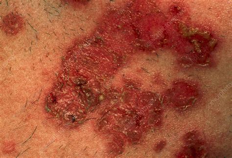 Staphylococcus Impetigo Skin Infection Stock Image M1800089