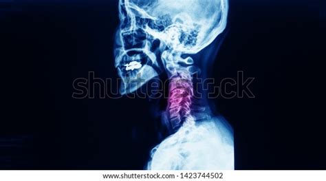 Lateral Projection Xray Cervical Spine Showing Stock Photo 1423744502