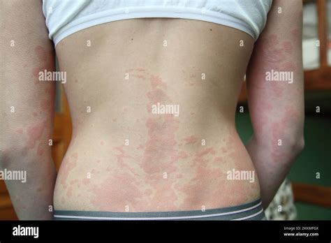 Skin Rash Urticaria Allergic Skin Hi Res Stock Photography And Images