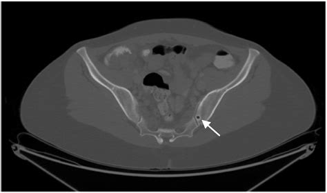 Benign Osseous And Articular Abnormalities Of The Pelvis A Review Of