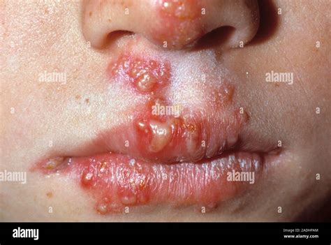 Cold Sores Around A Childs Nose And Lips Cold Sores Are Painful