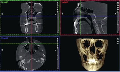 Display Of Structures Cone Beam Computed Tomography Cbct In Sagittal