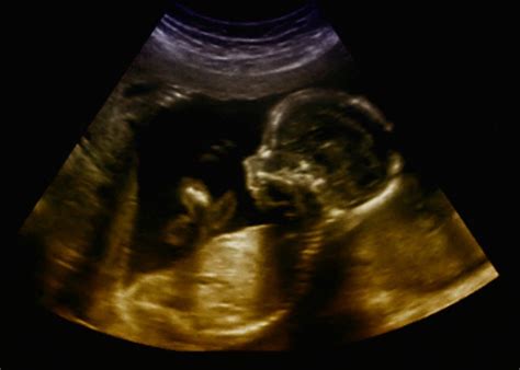 4 Pitfalls Of Bedside Ultrasonography During First Trimester Pregnancy