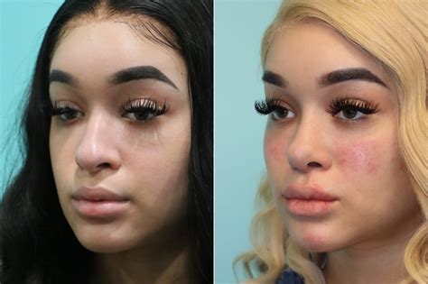 Cheeks Midface Injections Rhinoplasty Photos Chevy Chase Md Patient