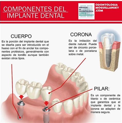 Odontología Clínica Moguillansky Implantes Dentales Y Rehabilitación