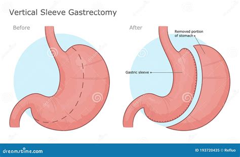 gastric sleeve resection vertical stomach reduction bypass operation tube fat surgery cross