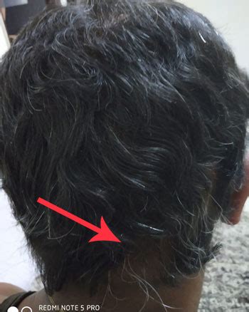 But even more men are concerned about the possible side effects of these treatments. Alopecia Areata Hair Regrowth Success Story
