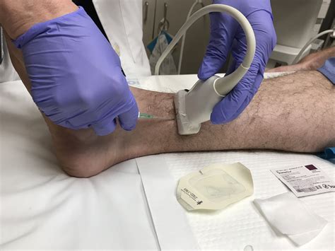 Us Saphenous Vein Cannulation Ultrasound Of The Month — Taming The Sru