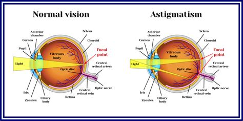 An Overview Of Lasik Surgery For Astigmatism Nvision Eye Centers