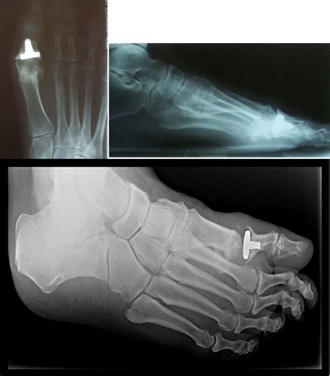 A Closer Look At A First Mpj Hemi Implant For The Treatment Of Hallux