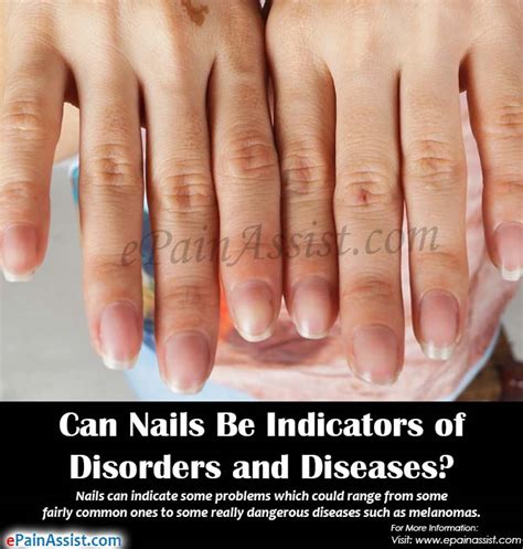 Can Nails Be Indicators Of Disorders And Diseases