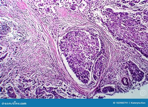 Breast Ductal Carcinoma Light Micrograph Stock Image Image Of