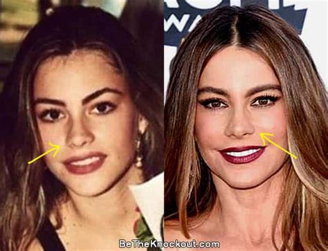 Sofia Vergara Plastic Surgery Comparison Photos