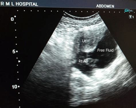 Pelvic Usg Showing Haemoperitoneum With Right Adnexal Mass Download