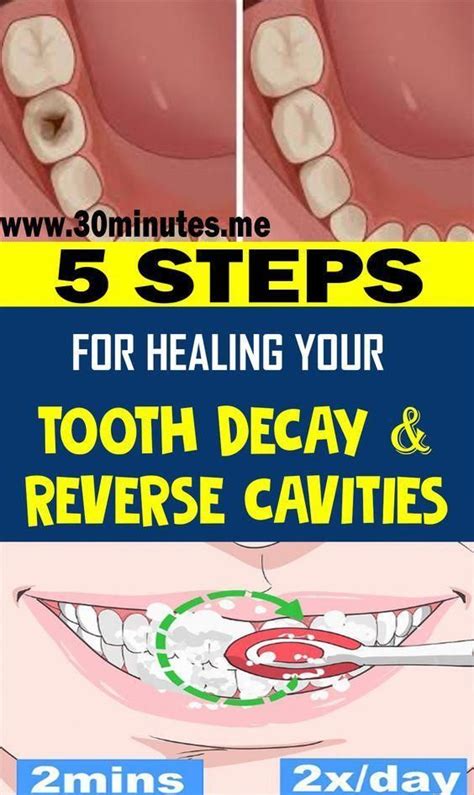 Enamel can repair itself by using minerals from saliva, and fluoride from toothpaste or other sources. Gratis Tooth Decay Nutrition #dentistafit # ...