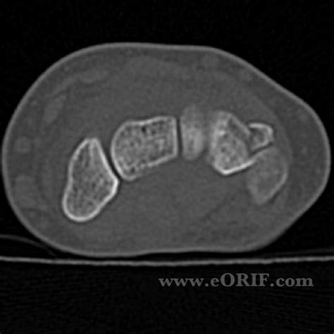 Triquetral Fracture S62.113A 814.03 | eORIF