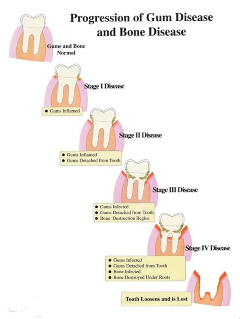 Stages Of A Loose Tooth News Dentagama