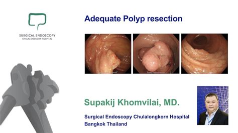 Adequate Polyp Resection Polypectomy Emr And Esd Youtube