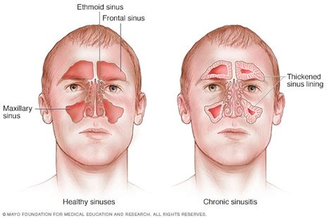 What is chronic sinusitis นกวชาการ Ark