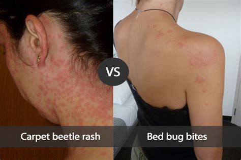 Carpet Beetle Rash Vs Bed Bug Bites Prime Pest Control London
