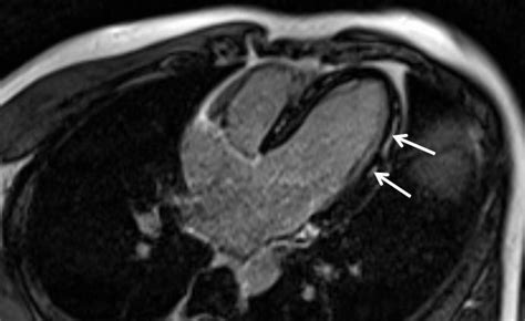 Myopericarditis Complicated By Pulmonary Embolism In An Immunocompetent