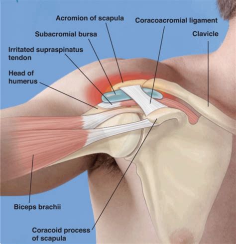 Supraspinatus Tendon Impingement Sexiz Pix