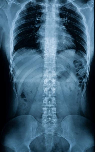 Spine Xray Stock Photos Pictures And Royalty Free Images Istock