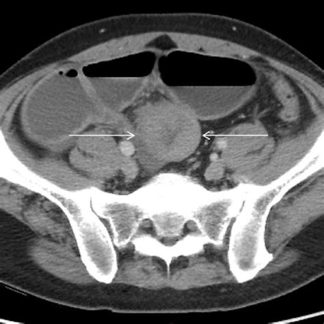 Ct Abdomen With Ileocecal Mass Arrows Measuring Approximately 475 Cm