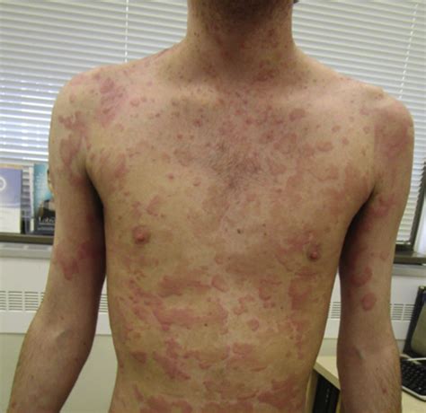 A Case Of Eosinophilic Annular Erythema As A Presenting Sign For