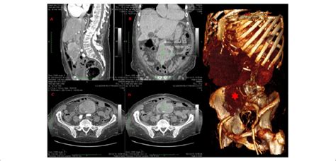 Computed Tomography Ct Imaging A Sagittal Ct Scan Late Arterial