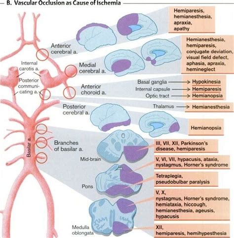 Vascular Occlusion Causes Of Ischemia Medical Neurology Nurse
