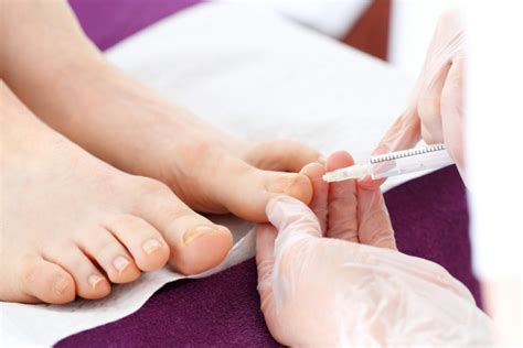 Toenail Removal Surgery Everything You Need To Know Gnfo