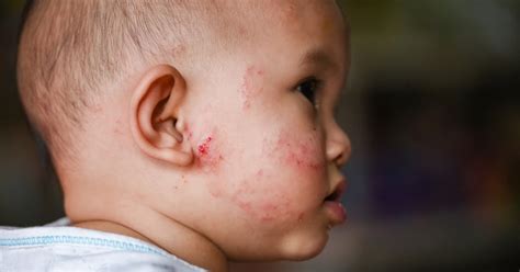 How To Get Rid Of My Babys Eczema 7 Easy Tips To Try Now
