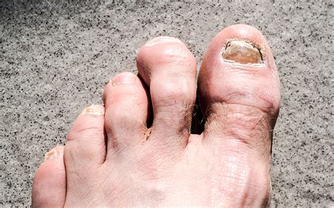 Torzítás Testvérek Jogász Hammer Toe Big Toe Táplálkoznak Cukor Vérfoltos