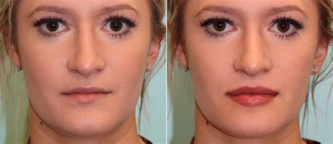 Lip Augmentation Photos Chevy Chase Md Patient 16139
