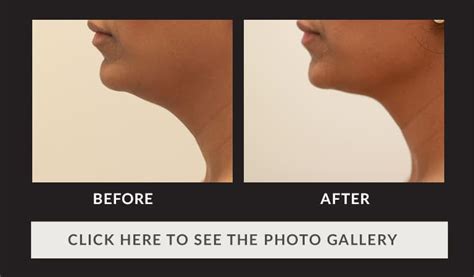 Chin Liposuction Houston And Katy Stubborn Fat Deposit Removal