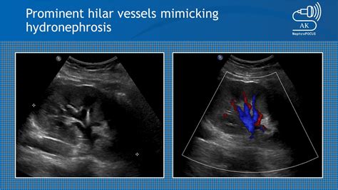 Vasculature Mimicking Hydronephrosis On Greyscale Ultrasound Nephropocus