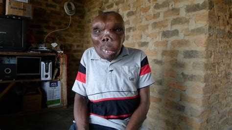 Man With Severely Deformed Head Who Was Crowned Ugandas Most Unusual