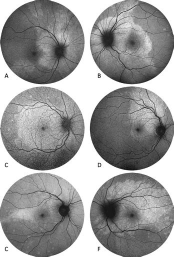 Indocyanine Green Angiography Features In Acute Syphilitic Posterior