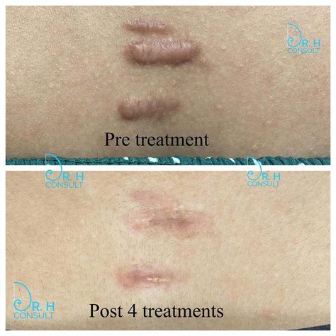 Keloid Scar Treatment Removal London Surrey Dr H Consult