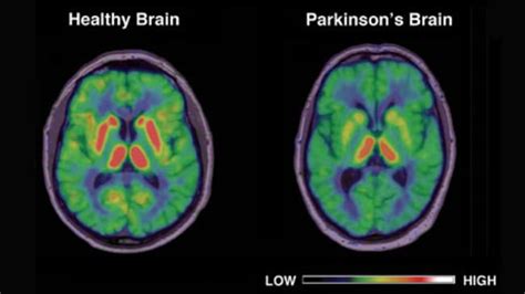 Parkinson's disease belongs to a group of movement disorders called parkinsonisms. Drug ice can cause changes in brain similar to Parkinson's disease, University of South ...