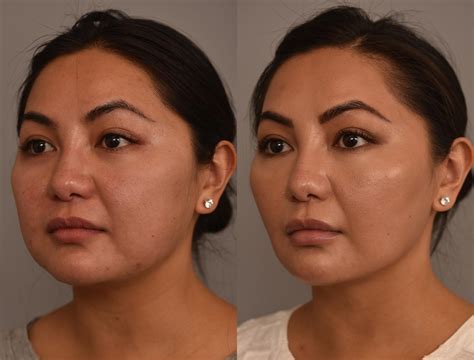 Face Liposuction Before And After