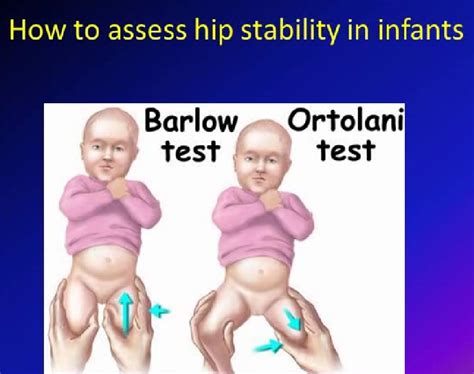 Developmental Dysplasia Of The Hip —