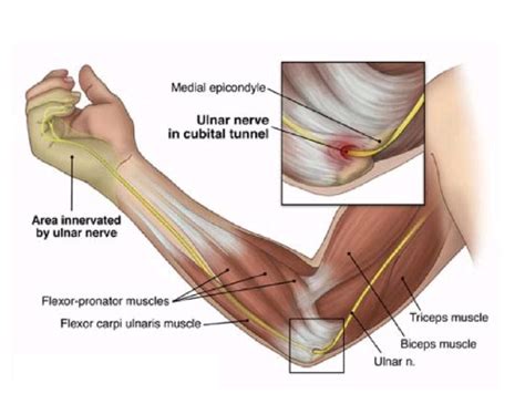 Cubital Tunnel Syndrome Advanced Hand