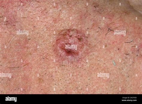 Close Up Of Basal Cell Carcinoma On The Cheek Of An Adult Male A Type
