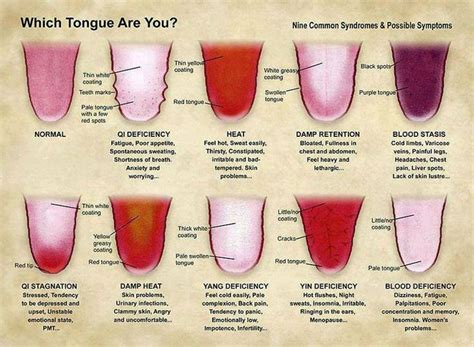Tcm Tongue Diagnosis Summary Picture Chart Tongue Health Qi Deficiency Red Tongue