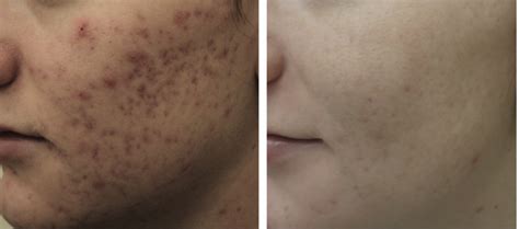 Laser Treatment For Acne And Acne Scars In Crest Hill And Naperville