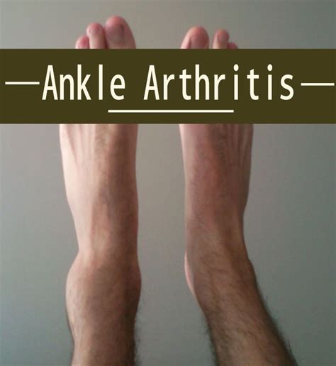 12 Best Arthritis Pain Relief Images On Pinterest Arthritis Pain