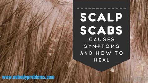 Scalp Scabs Causes Symptoms And How To Heal No Body Problems